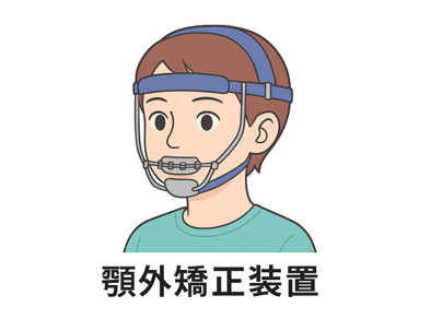 顎外矯正装置(顔の外に装着)