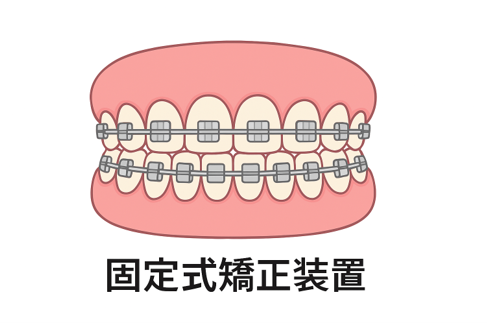 固定式矯正装置(取り外し不可)
