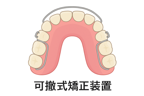 可撤式矯正装置(取り外し可能)